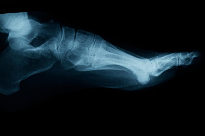 CBD for Gout: A Review of the Evidence