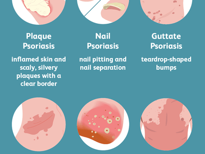 What Does Research Say About CBD and Psoriasis?